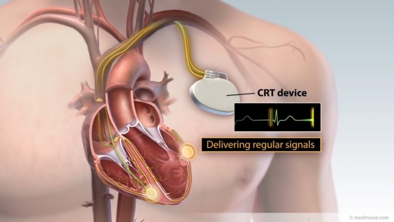 Angioplasty Guide